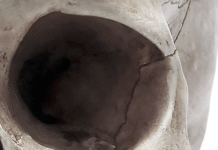 Cohesys Reports First Clinical Use of Investigational BoneTape Device in Craniofacial Fracture Repair